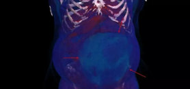 FOTO // Descoperire macabră: O femeie credea că este însărcinată, însă medicii au fost șocați de ce au văzut în pântecul ei